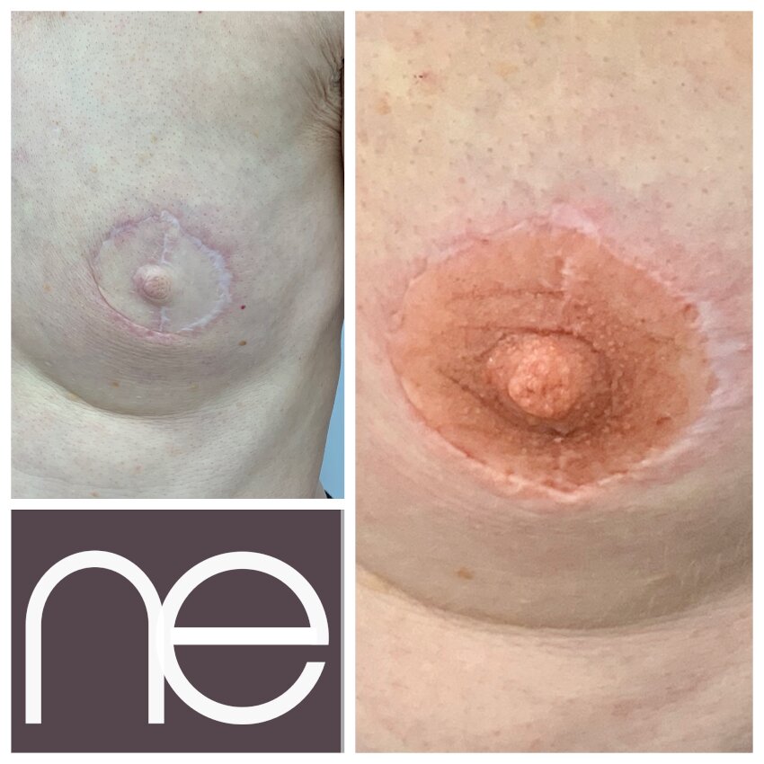 Natural Enhancement Semi Permanent Areola Before And After