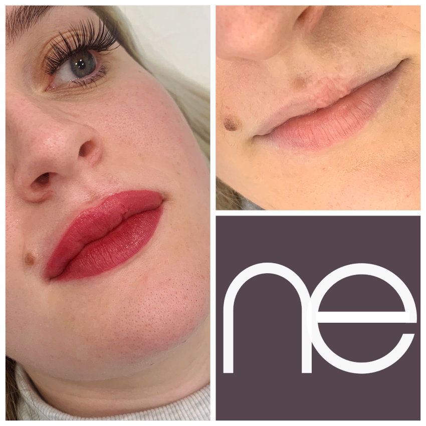Cleft Palate Tattoo London Cleft Palate Restoration