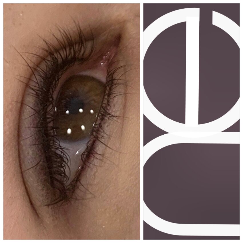 Natural Enhancement Semi Permanent Scar Camouflage Before And After