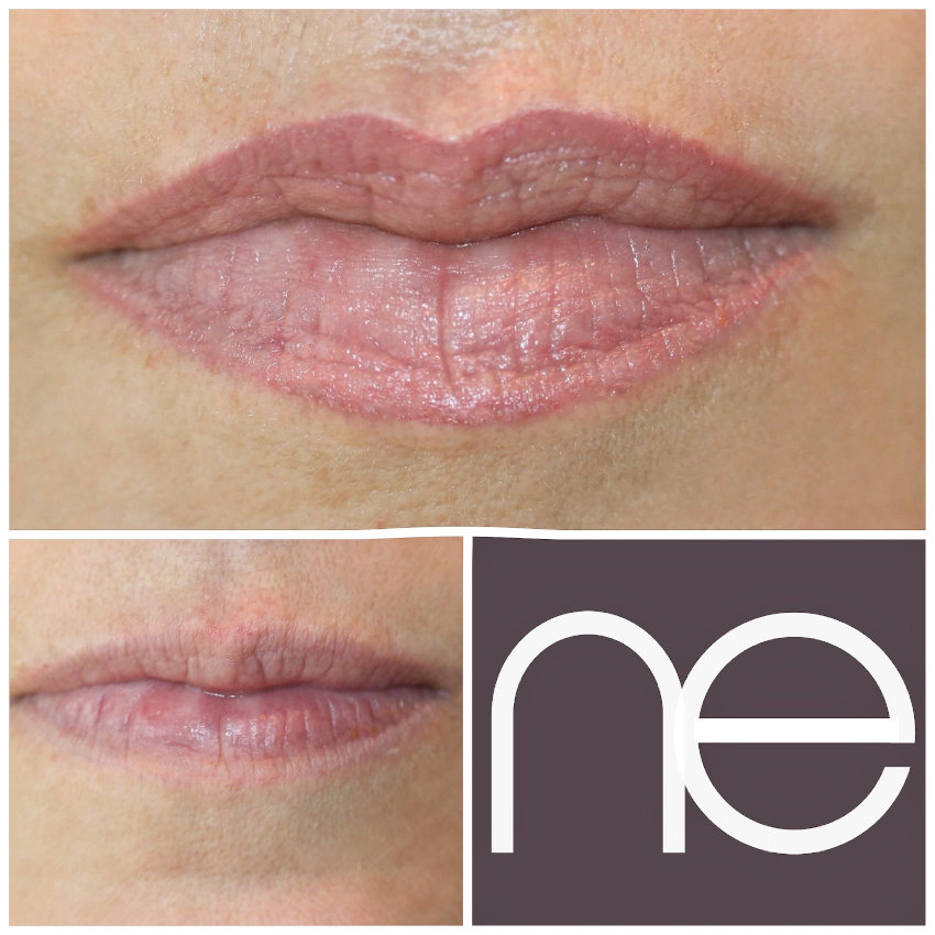 Natural Enhancement Semi Permanent Lips Before And After