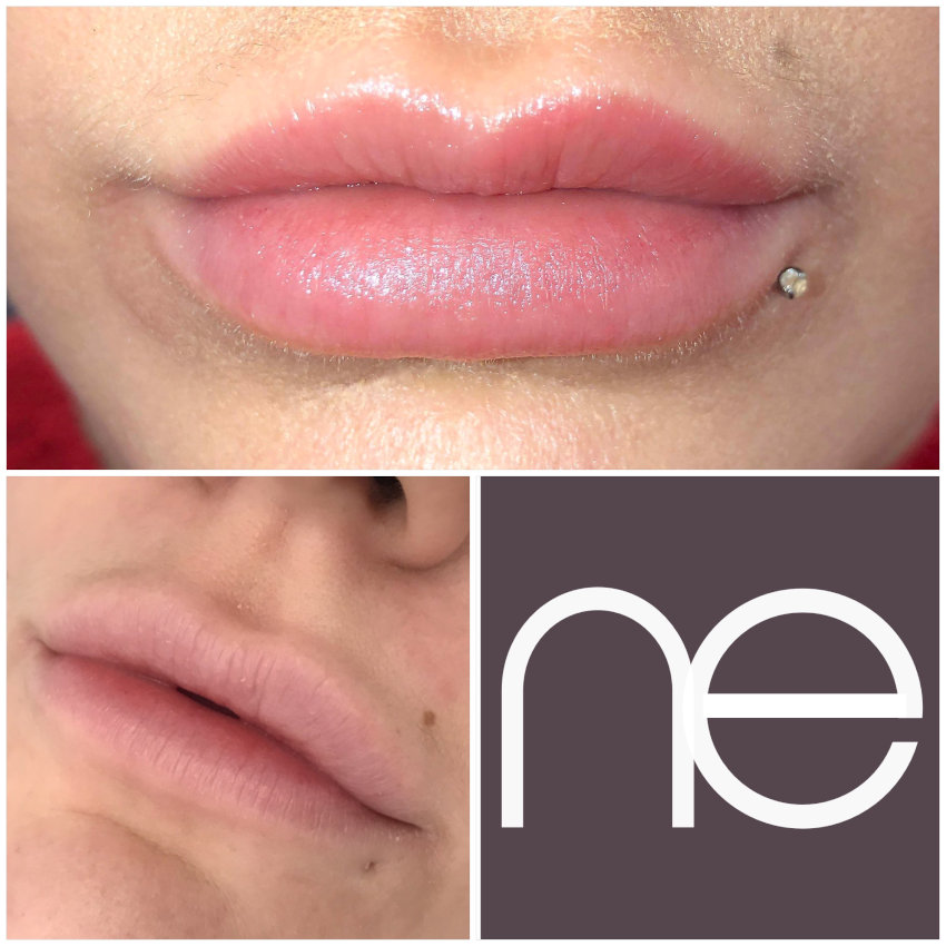 Natural Enhancement Semi Permanent Lips Before And After