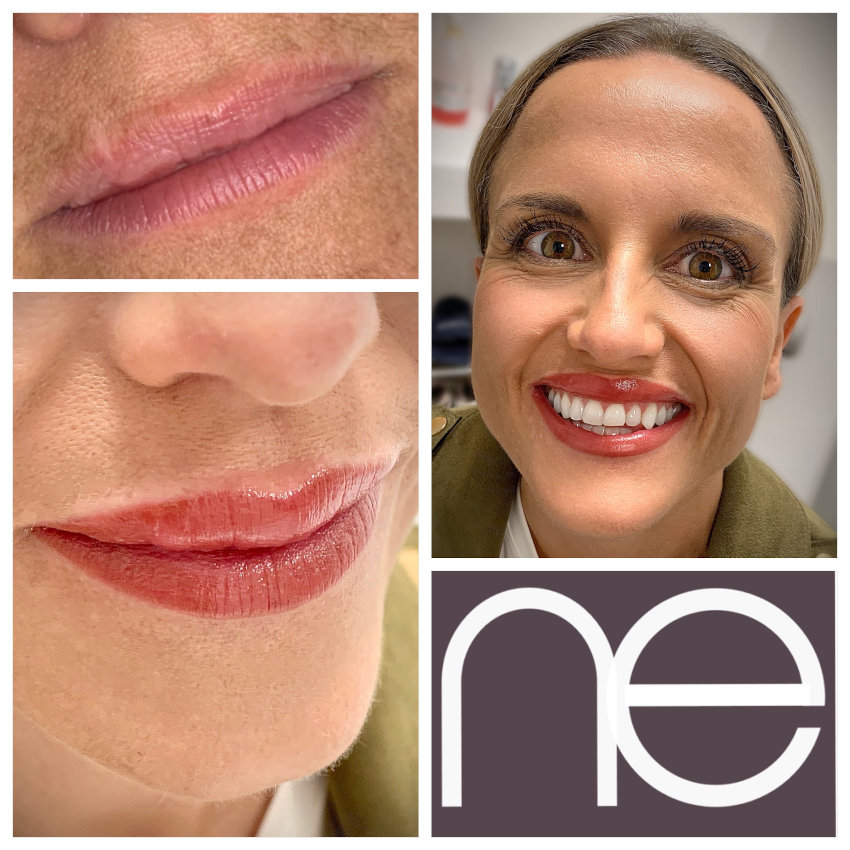 Natural Enhancement Semi Permanent Scar Camouflage Before And After