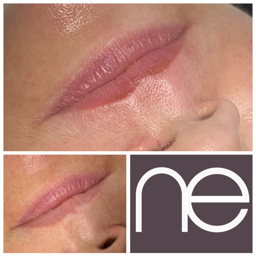 Natural Enhancement Semi Permanent Scar Camouflage Before And After