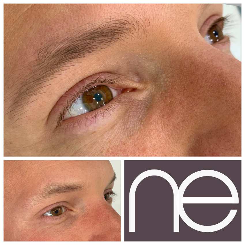 Natural Enhancement Men Before And After