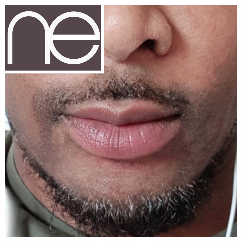 Natural Enhancement Men Before And After