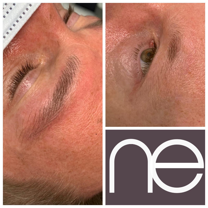 Natural Enhancement Men Before And After