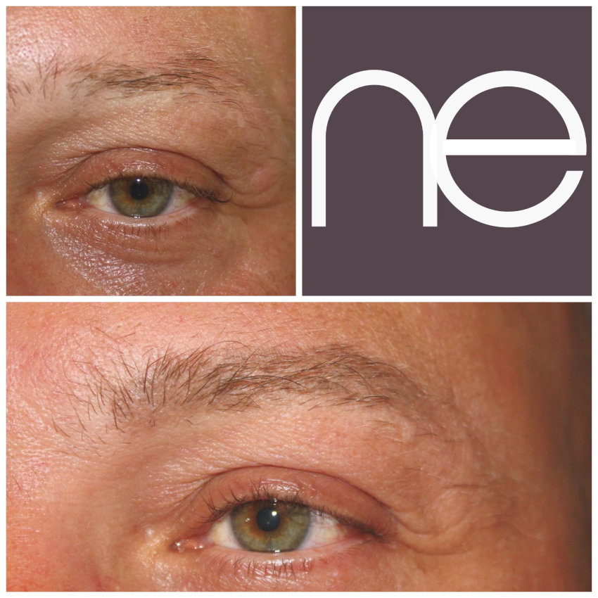 Natural Enhancement Men Before And After