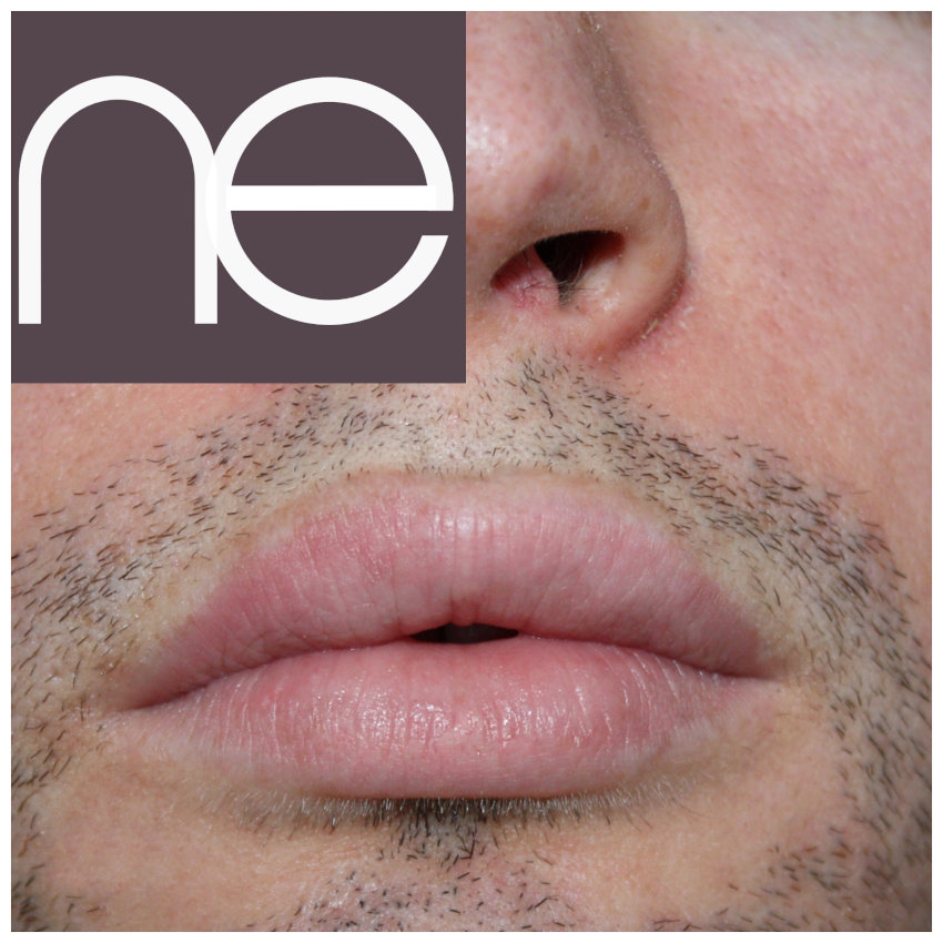 Natural Enhancement Men Before And After