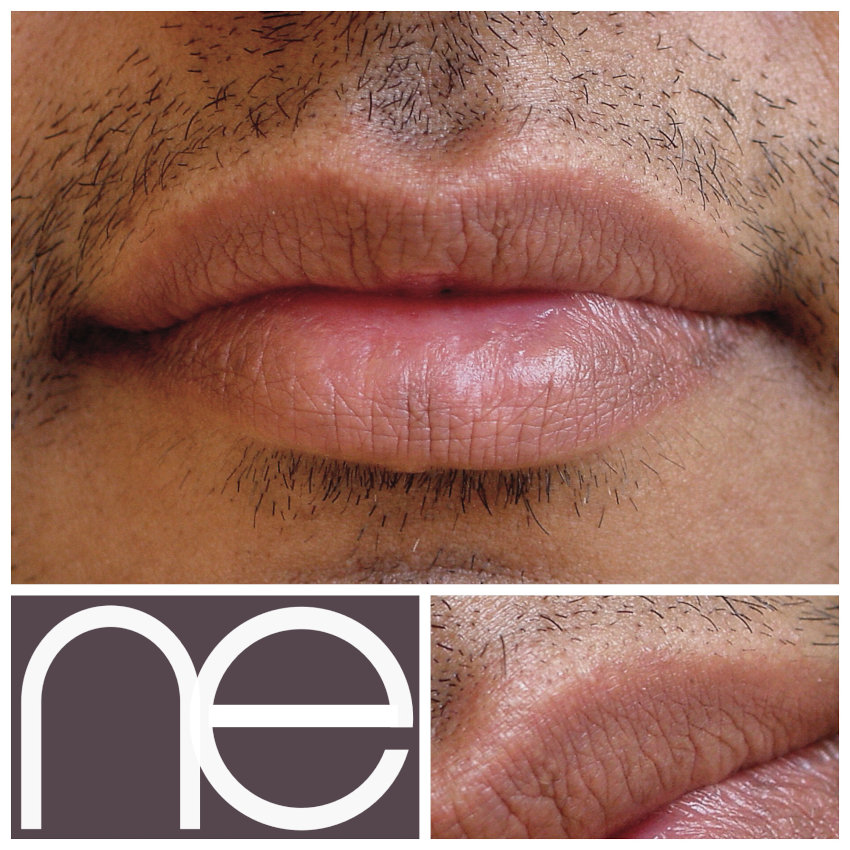 Natural Enhancement Men Before And After