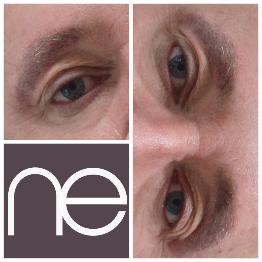 Natural Enhancement Men Before And After