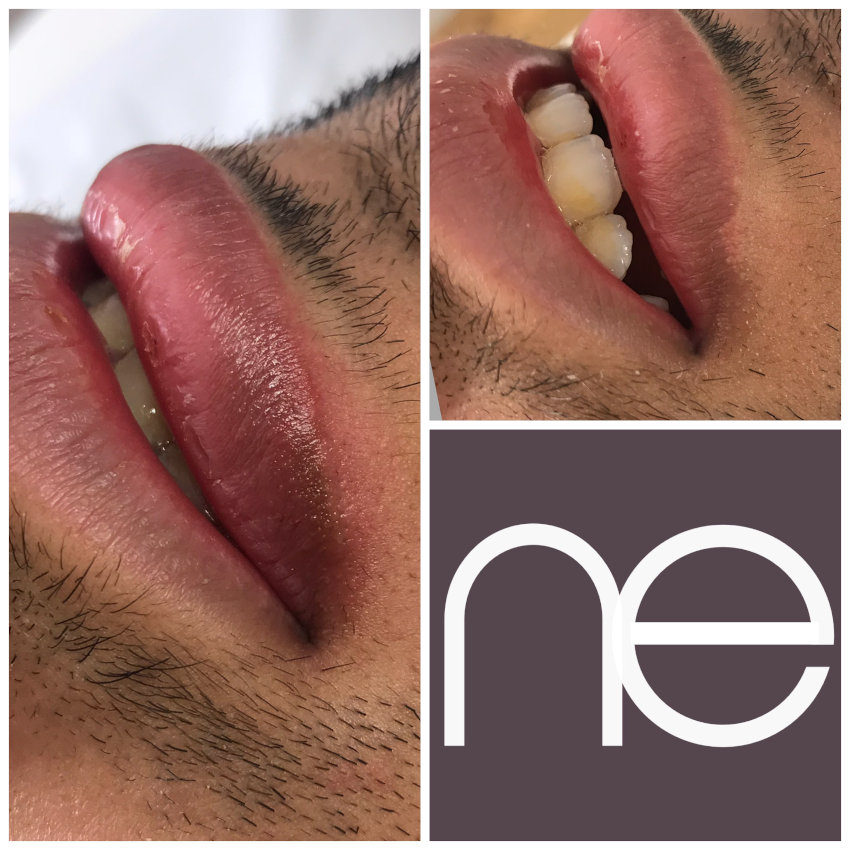 Natural Enhancement Men Before And After