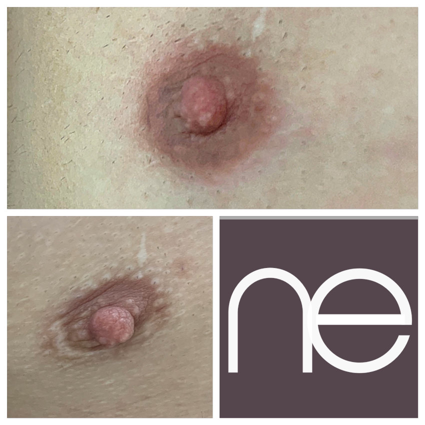 Natural Enhancement Semi Permanent Scar Camouflage Before And After