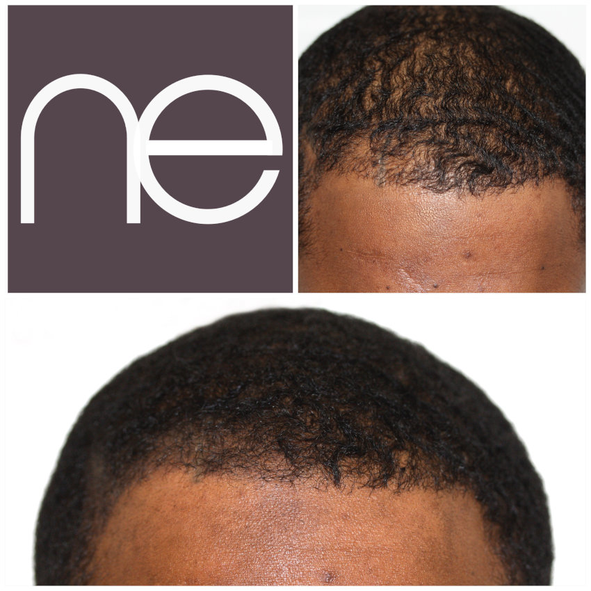 Natural Enhancement Semi Permanent Hair Tattoo Before And After