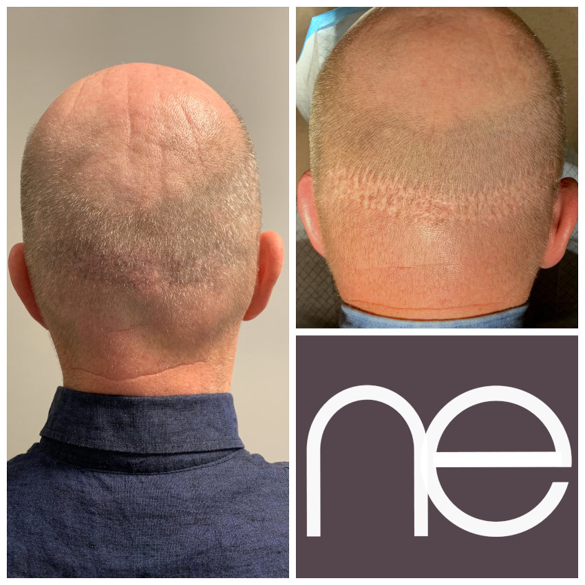 Natural Enhancement Semi Permanent Hair Tattoo Before And After
