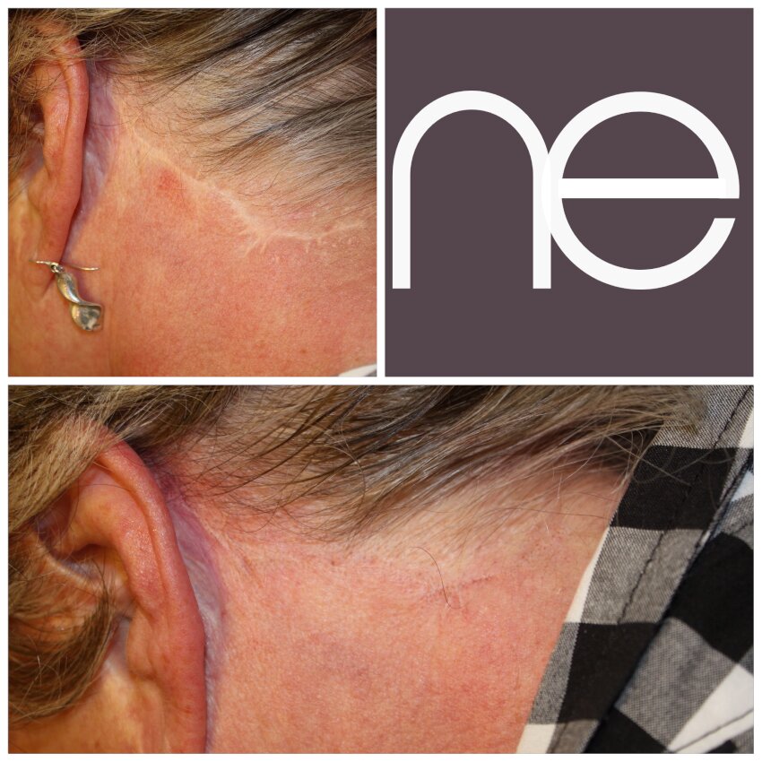 Natural Enhancement Semi Permanent Scar Camouflage Before And After