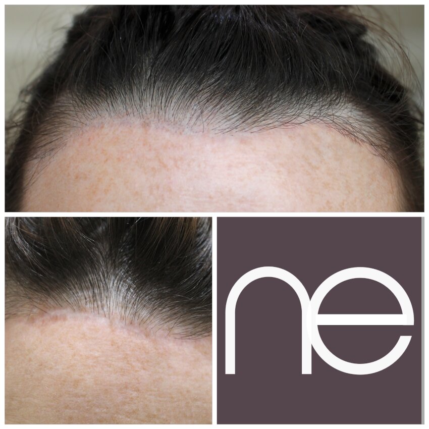 Natural Enhancement Semi Permanent Scar Camouflage Before And After