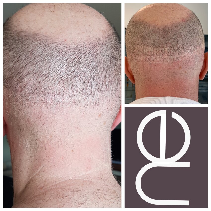 Natural Enhancement Semi Permanent Scar Camouflage Before And After