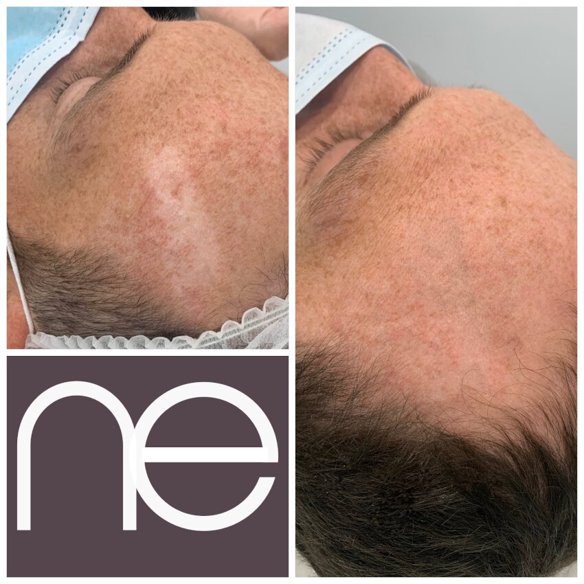 Scar Camouflage London Camouflage Tattoo Scar Camouflage Tattoo