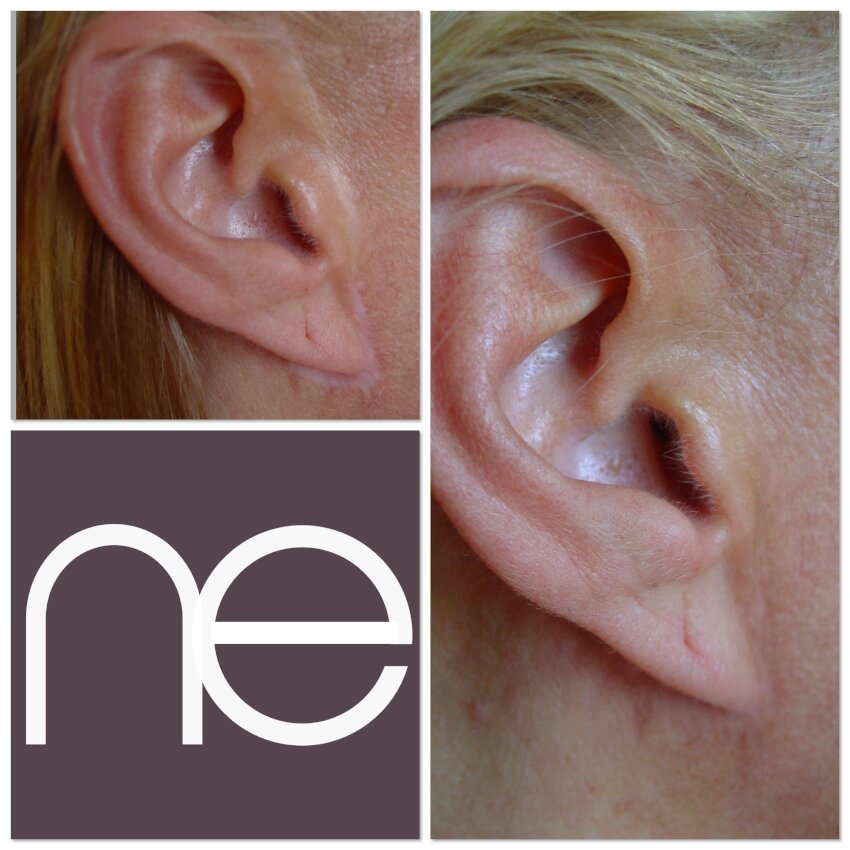 Natural Enhancement Semi Permanent Scar Camouflage Before And After