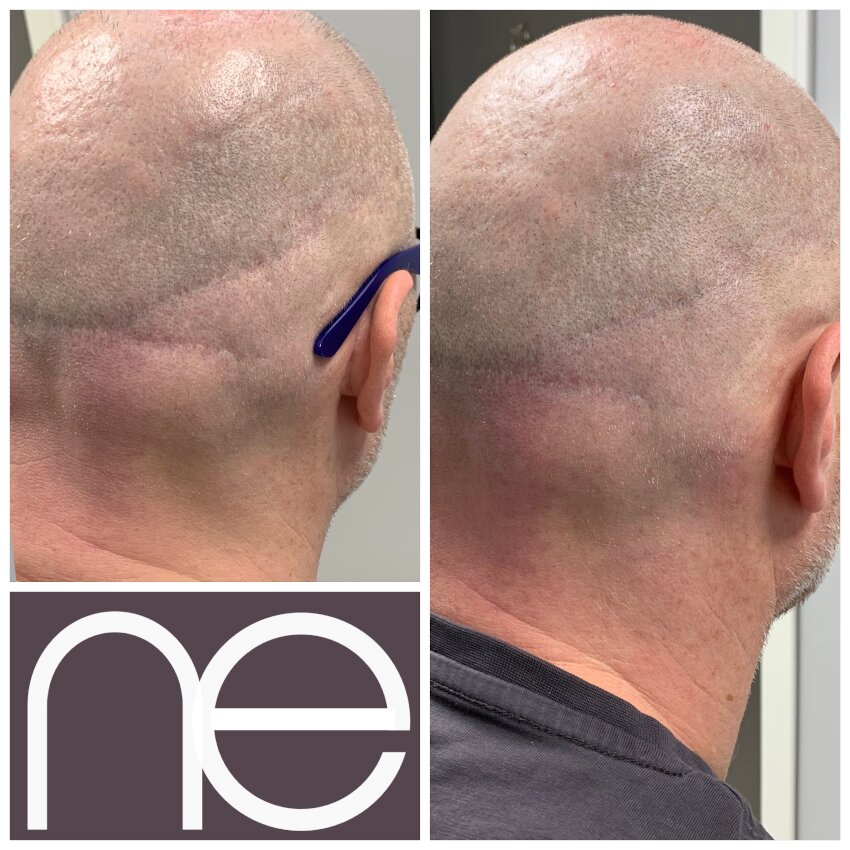 Natural Enhancement Semi Permanent Scar Camouflage Before And After