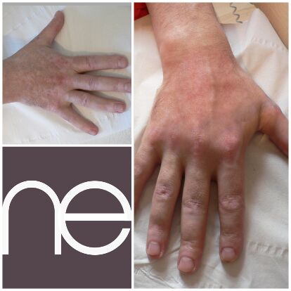 Natural Enhancement Semi Permanent Vitiligo Before And After