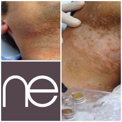 Natural Enhancement Semi Permanent Vitiligo Before And After