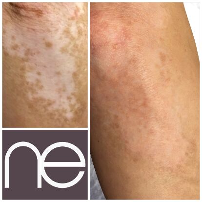 Natural Enhancement Semi Permanent Vitiligo Before And After