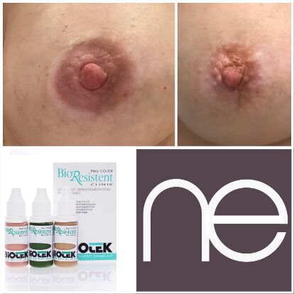 Natural Enhancement Semi Permanent Vitiligo Before And After