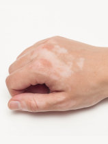 Vitiligo Re-Pigmentation