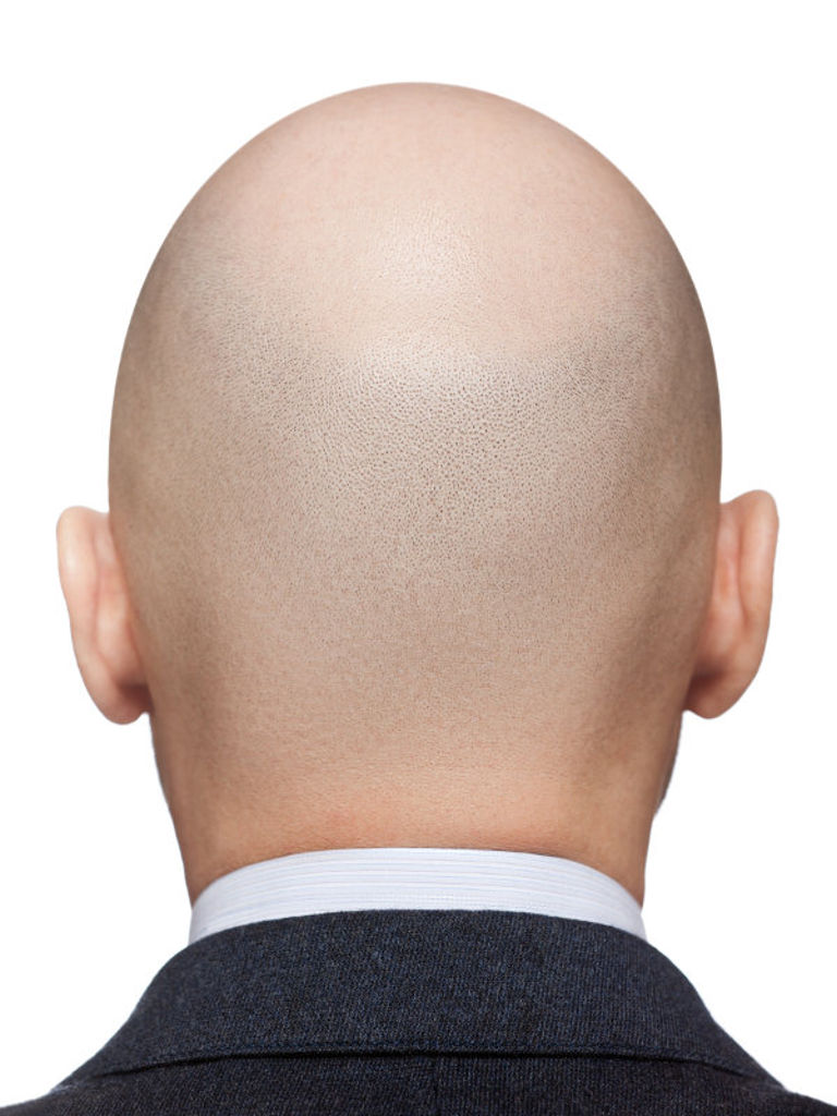 Scalp Micropigmentation Specialists London  HAIR ink Clinic