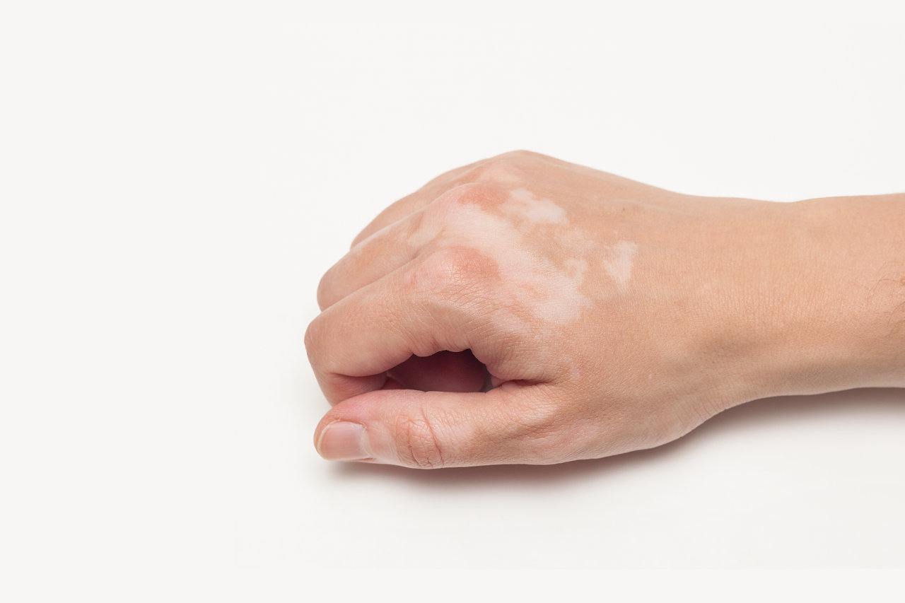 Vitiligo Re-pigmentation Treatments