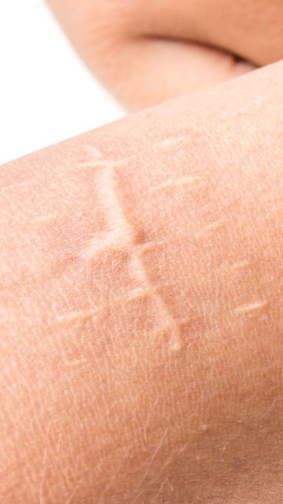 Immortal Lab - Brazilian Mark Camouflage Procedure Although stretch marks  are a typical, yet annoying part of life, most people wish that they could  make them permanently disappear. There is an entire