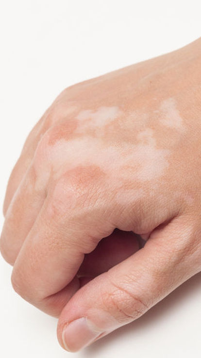 Vitiligo Tattoo Cover Up | Natural Enhancement London