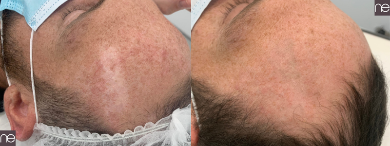 Scar Camouflage in London